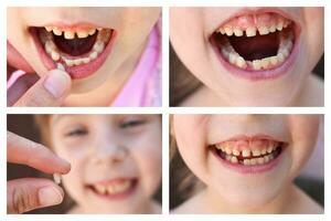 A collage of the child has lost the baby tooth. photo