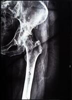 negative x-ray of junction of tibia and pelvis photo