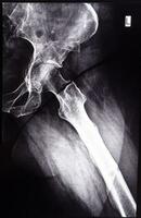 negative x-ray side view of acetabular cavity photo