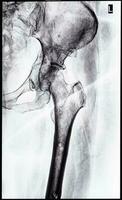 x-ray of junction of tibia and pelvis after healed photo