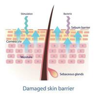 Damaged skin barrier vector on white background. The sebum barrier decreased, tight arrangement between the skin cells is lost.  Skin care and beauty concept illustration.