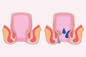 pila de algo. hemorroidal enfermedad. comparación y diferencias Entre sano recto y parte de un grande intestino con interno y externo hemorroides, pectinado línea y rectal sangrado vector