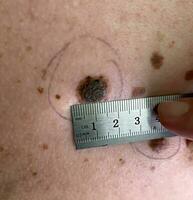 Measuring the size of a mole on human skin. photo