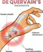 Illustration of de quervain syndrome or tenosynovitis vector