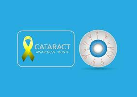 Cataract awareness month is observed every year in June. Vector illustration of eyeball with cloudy lens in cataract patient.