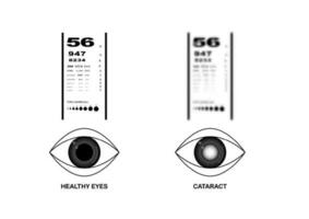 Comparison of healthy eyes and cataract eyes vision on eye examination chart. vector