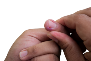 selective focus on bruised middle fingernails due to ingrown nails. in Indonesian it is called cantengan. paronychia disease. png