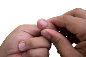 selective focus on bruised middle fingernails due to ingrown nails. in Indonesian it is called cantengan. paronychia disease. png