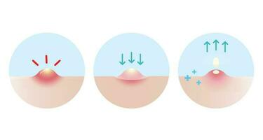 dirección para utilizar acné espinilla parche para inflamatorio acné vector icono conjunto ilustración en blanco antecedentes. cómo a usar, paso para utilizar acné parche absorbente pústula en piel rostro. piel cuidado concepto.