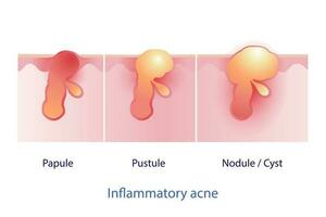 tipos de inflamatorio acné vector en blanco antecedentes. pápula, pústula, nódulo y quiste. piel cuidado y belleza concepto ilustración.