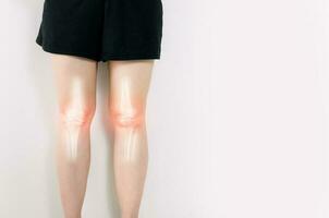 Human leg Osteoarthritis inflammation of bone joints photo