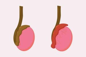 illustration of epididimitis. inflamasi epididimis. Epididymitis is inflammation of the epididymis which is generally caused by a bacterial infection vector