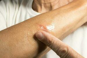 Man applying ointment to a small minor first degree burn on his forearm photo