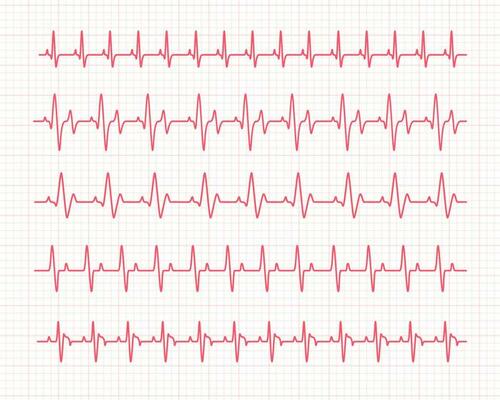 heart rhythm graph Checking your heartbeat for diagnosis