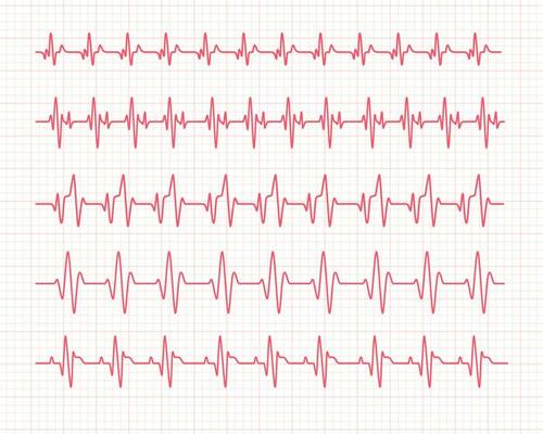 heart rhythm graph Checking your heartbeat for diagnosis
