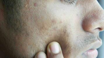 Close up of young man face with skin problem video