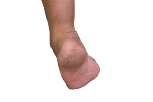 el suelas de el pies agrietado desde sequedad png