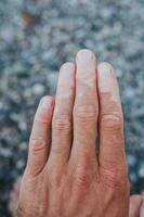 el problema de solar radiación en el piel en el formar de lugares - un violación de pigmentación - un hombre mano con blanco lugares foto