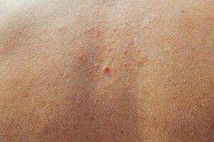 Seborrhea on the skin of the back - skin conditions treatment at a seaside resort - dry skin and inflammation photo