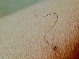Mole birthmark nevus macro photo on human skin with hair. close up,blurred background with bokeh images.