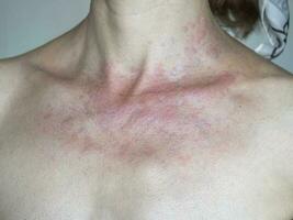 Solar dermatitis. Woman with red sunburned skin against gray background, closeup. photo