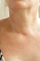 cuello cicatriz después tiroidectomía. de cerca foto