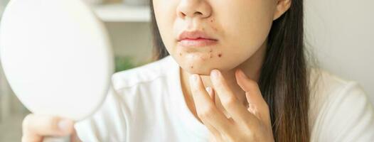 Expression worry asian young woman hand touching pustule around the chin and mouth, allergic when wear mask, makeup, show squeezing pimple spot from face. Beauty care, skin problem by acne treatment. photo