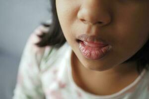 closeup of dry lip of a baby photo