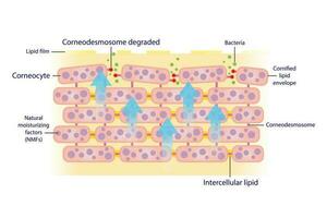 The mechanism of exfoliating corneocyte, skin cells vector isolated on white background. Corneodesmosome degraded by enzymes, sebum barrier decreased. This allows bacteria to get in skin easier.