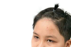 Skin rash and acne on forehead boy isoalted on white photo