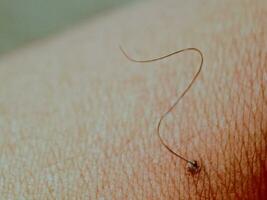 Mole birthmark nevus macro photo on human skin with hair. close up,blurred background with bokeh images.