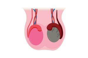 illustration of epididimitis. inflamasi epididimis. Epididymitis is inflammation of the epididymis which is generally caused by a bacterial infection vector