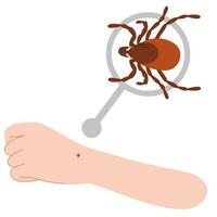 The human hand with the tick bite. Tick bite hand.Tick bite. Healthcare illustration. vector