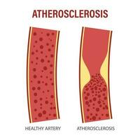 sano y aterosclerótico vasos con sangre células. colesterol en sangre vasos aterosclerótico placa. medicamento, ciencia, cuidado de la salud. infografia bandera vector