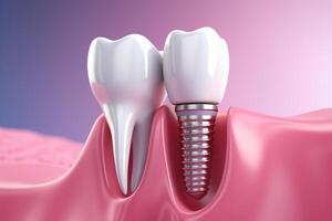 Dental implantation, teeth with implant screw, illustration. photo