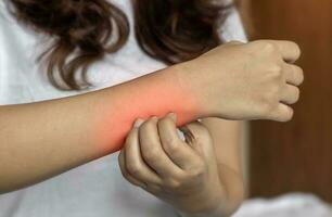 Asian woman scratching lower arm. Itchy skin diseases such as scabies, fungal infection, rash, etc. photo