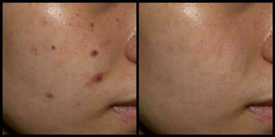 Before and after treatment of acne, black spots and freckles on face of Asian woman. photo