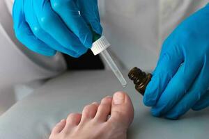 A doctor in medical gloves drips medicine from a pipette onto a sore finger. Close-up of a foot with nail fungus. Onycholysis detachment of the nail from the nail bed. photo