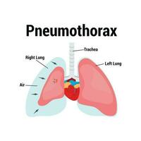 symptoms of pneumothorax lung vector