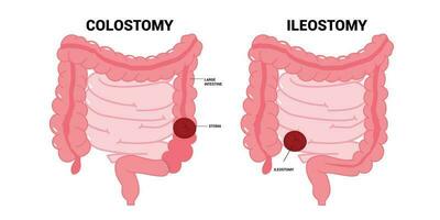 The ileum stoma abdomen Pouch for blocked poo stool system of Small Large Colon with Crohn and Hirschsprung disease inflammation Surgery hernia Cancer tract Rectal Tumor Loop invasive removal vector