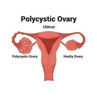 Illustration of Polycystic ovary vector