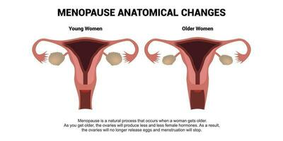 Menopause anatomical changes. Comparison of female reproductive system of young woman and older woman with explanations. Realistic anatomy vector illustration