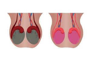 illustration comparation of normal epididimis and testis, and abnormal epididimis and testis. epididimitis orchitis. eps 10 vector