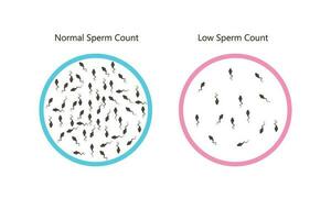 normal and low sperm count illustration. Male infertility oligospermia. Structure of the sperm. Vector. eps 10 vector