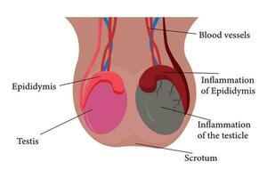 illustration of epididimitis. inflamasi epididimis. Epididymitis is inflammation of the epididymis which is generally caused by a bacterial infection vector