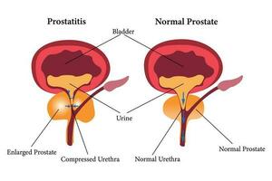 comparation of health prostate and unhealth prostate. prostatitis illustration icon set. eps 10 vector