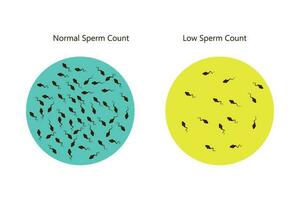 normal and low sperm count illustration. Male infertility oligospermia. Structure of the sperm. Vector. eps 10 vector