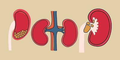 A set of kidneys with stones inside. Vector illustration in flat style