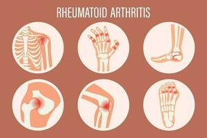 Rheumatoid arthritis icons. Knee joint, shoulder joint, wrist joint, hip joint, foot joint. Types of arthritis. Medical concept. Vector