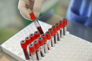 lab technician hand checking patient blood tube before submitting test, selective focus photo